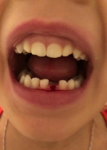 loose baby teeth