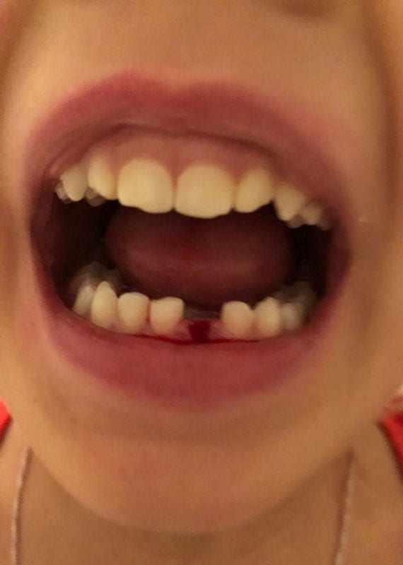 loose baby teeth loose baby teeth